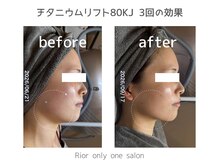 リオル(Rior)の雰囲気（チタニウムリフトが出来る／ハーブピーリング／フォト）