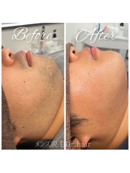 ドクターヘア 徳島店(Dr.hair)/モニター様の症例画像です！(横)