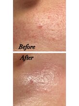 ステラ(Stella)/メニュー【毛穴汚れ・角栓吸引】