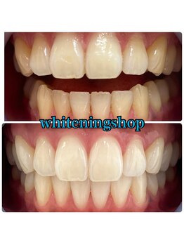 ホワイトニングショップ 吉祥寺店/BEFORE ＆ AFTER