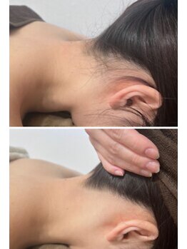 ミース 江坂店/うなじ●ビフォーアフター江坂店