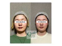 キュープ 大阪中百舌鳥店(Qpu)/フェイスラインが変わります