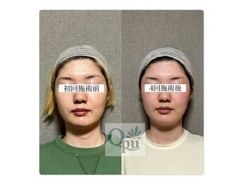 キュープ 大阪中百舌鳥店(Qpu)/フェイスラインが変わります