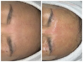 ヴェーラベレッツァ(Vera Bellezza)/眉間のシワ改善(1回目)