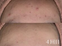 アワピール 天王寺店(AWA PEELL)/ハーブピーリング/ニキビケア