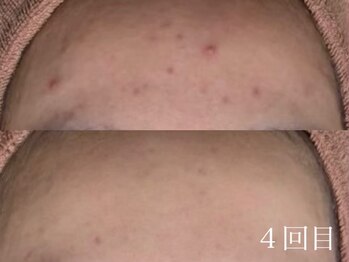 アワピール 天王寺店(AWA PEELL)/ハーブピーリング/ニキビケア