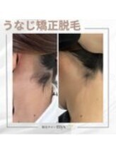 ミース 豊田店/うなじ矯正◆ビフォーアフター