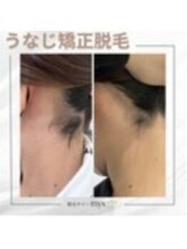 ミース 豊田店/うなじ矯正◆ビフォーアフター