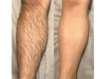 バタフライ 平塚店(Butterfly)/メンズ脱毛