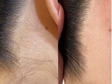 モストブリヤン(MOSTBURYAN)/うなじWAX脱毛