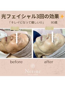 ネリネ(Nerine)/光フェイシャル3回の効果！