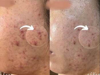 エヌエースキン たまプラーザ店(NAskin)/ハーブピーリング|ニキビケア