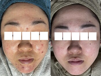 リボーン(REBORN)/ハーブピーリングの力