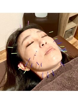 あらき鍼灸整体院の写真/【美容だけじゃない美容鍼！】自律神経の乱れに特化してる当院の美容鍼！疲れ顔にも◎耳つぼジュエリーも☆