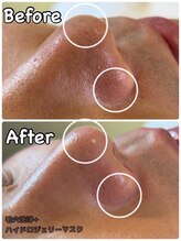 バイカラー(BY COLOR)/【ハイドラ毛穴洗浄】