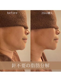 サンポ 神戸元町店(SANPO)/20ml導入