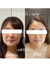 ソラ(sola*)/血流も改善肌色UP
