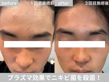 サロン ビュー(salon view)/10代男性〈ニキビ悩み〉