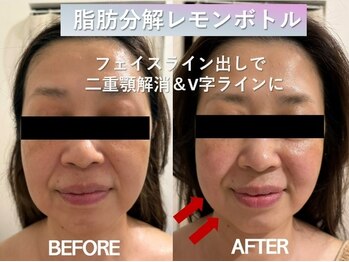 ラディアント(Radiant)/インディバ/レモンボトル