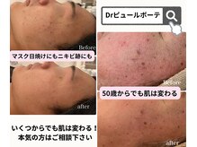 カラン(CALIN)/シミケア