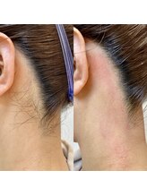 ヒスイ バイ アメイジング(Hisui by AMAZING)/【ワックス脱毛】うなじ