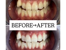 ホワイトニングサロン 宝塚/Before&After美白ホワイトニング