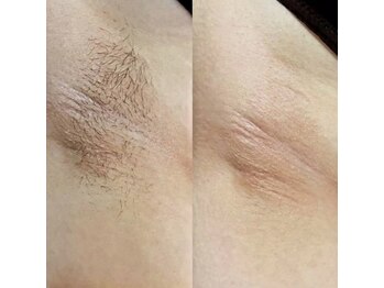 シアージュ(ciage.)/【WAX脱毛】両脇