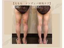 オキシー グレイス 黒崎店(OXY Grace)/太もも術後インディバ