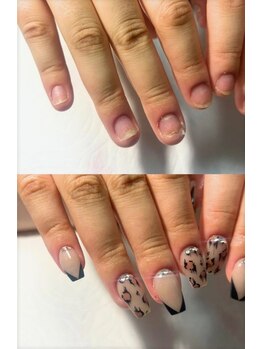 ピノ(pino)の写真/\長年のお悩み改善/深爪矯正専門店【人気No.1★NGなし深爪矯正+スカルプアートし放題(メモリ2)¥22000】