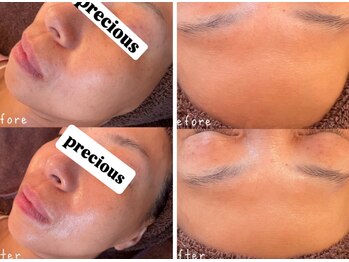 プレシャス(Precious)/ハーブピーリング/エイジング