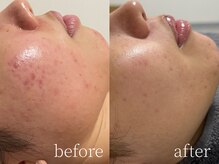 ルーム(lume)/ハーブピーリング before/after