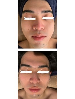 ビーアンドアイ シズオカテン メンズ(B＆I SHIZUOKA)/フェイスラインリフト