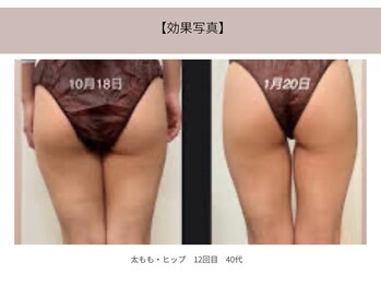 ミライ 福岡筑紫野店(mirai)/ヒップ太もも集中コース