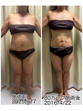 クールスパ(COOL SPA)/50代女性 お腹症例