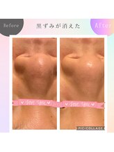 パルティノ 高崎店/光エステ