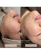 タグ 高知駅前店(Tug)/【お顔のニキビケア・跡】