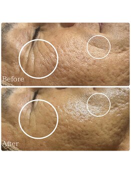 エース(ACE.)/エイジングライン改善!