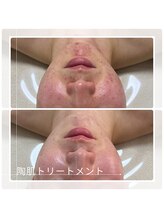 アチェリー(aCherry)/陶肌トリートメント