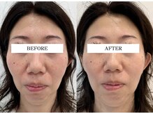 ハリランス(HARILANCE)/小顔/むくみ解消