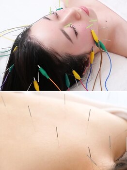 鍼灸施術を受けたい