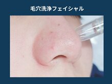 アポロ(Apollo)/【メンズ脱毛＋フェイシャル】