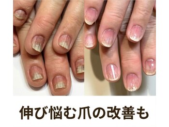 ティアラネイル 宇都宮/深爪矯正