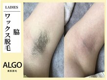 アルゴ 飯塚店(ALGO)/脇ワックス脱毛