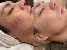 メディカルサロン フィオレ(fiore)の雰囲気（何度も繰り返すニキビにアプローチ！メンズにもオススメ☆）
