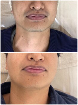 モット いこらもーる泉佐野店(mot)/メンズお顔脱毛