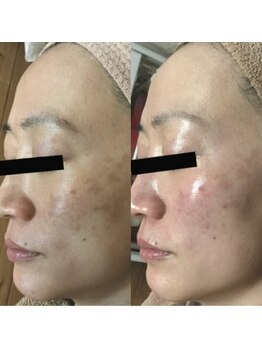 ホワイトアクア 梅田本店(WHITE AQUA)/ララピール/大阪/梅田/毛穴/小顔