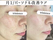 トリニエンス 新宿店(TRINIENCE)/30代/シミケア/パーソナルケア
