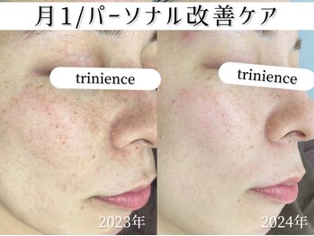 トリニエンス 新宿店(TRINIENCE)/30代/シミケア/パーソナルケア