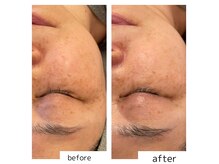 肌トラブルのシミ/クスミ改善【美肌育成専門店】