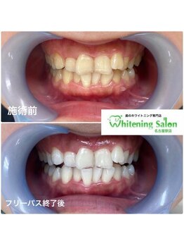 ホワイトニングサロン 名古屋駅店/【ホワイトニング施術例】